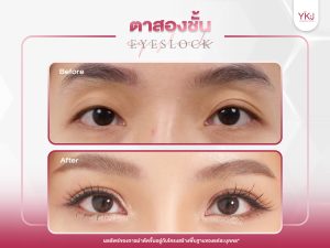 ภาพก่อนหลังทำตาสองชั้น , ภาพก่อนหลังแก้ตาสองชั้น
