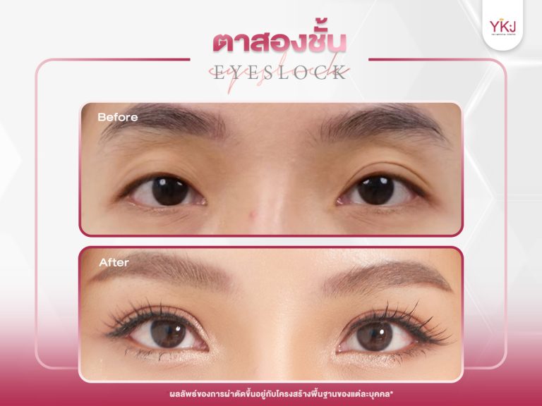 ภาพก่อนหลังทำตาสองชั้น , ภาพก่อนหลังแก้ตาสองชั้น