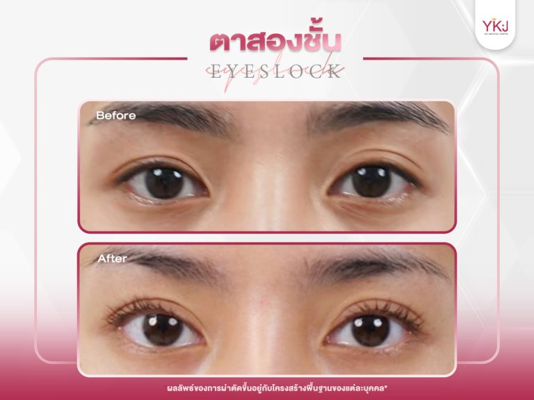 ภาพก่อนหลังทำตาสองชั้น , ภาพก่อนหลังแก้ตาสองชั้น