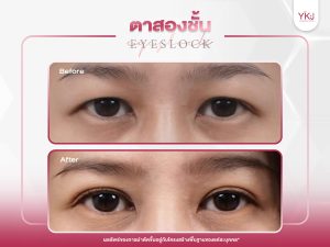 ภาพก่อนหลังทำตาสองชั้น , ภาพก่อนหลังแก้ตาสองชั้น