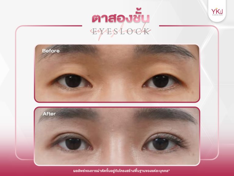 ภาพก่อนหลังทำตาสองชั้น , ภาพก่อนหลังแก้ตาสองชั้น