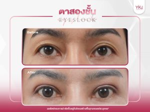 ภาพก่อนหลังทำตาสองชั้น , ภาพก่อนหลังแก้ตาสองชั้น
