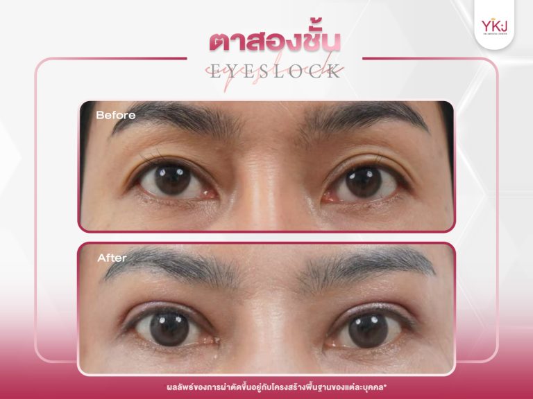 ภาพก่อนหลังทำตาสองชั้น , ภาพก่อนหลังแก้ตาสองชั้น