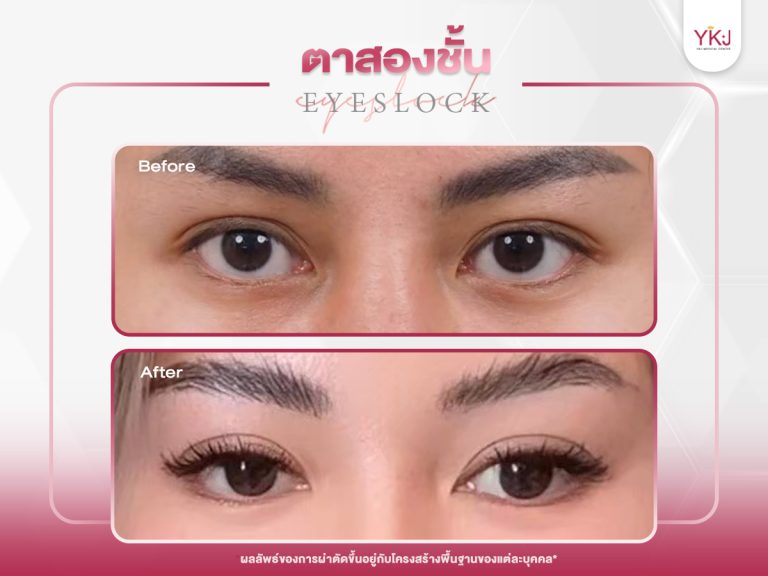 ภาพก่อนหลังทำตาสองชั้น , ภาพก่อนหลังแก้ตาสองชั้น