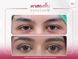 ภาพก่อนหลังทำตาสองชั้น , ภาพก่อนหลังแก้ตาสองชั้น