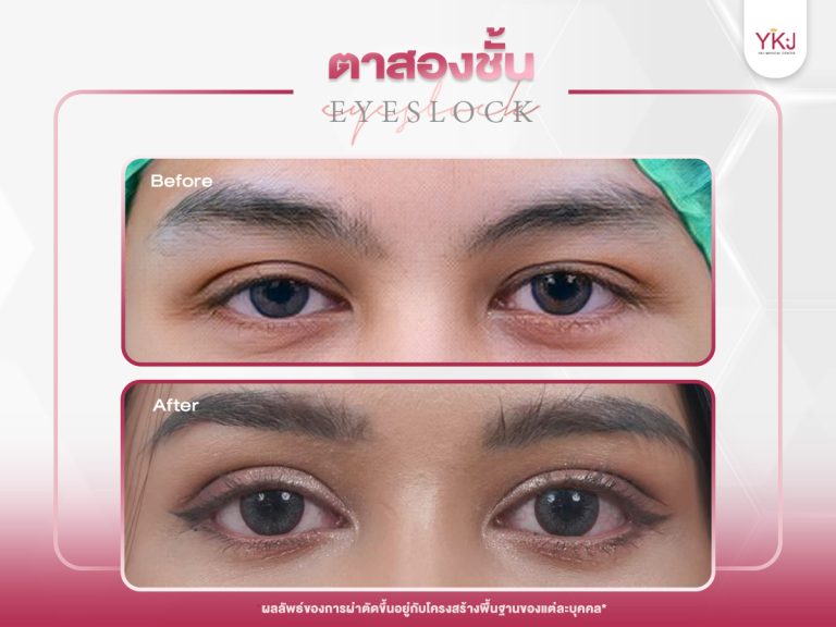 ภาพก่อนหลังทำตาสองชั้น , ภาพก่อนหลังแก้ตาสองชั้น