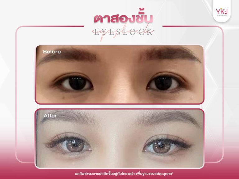 ภาพก่อนหลังทำตาสองชั้น , ภาพก่อนหลังแก้ตาสองชั้น