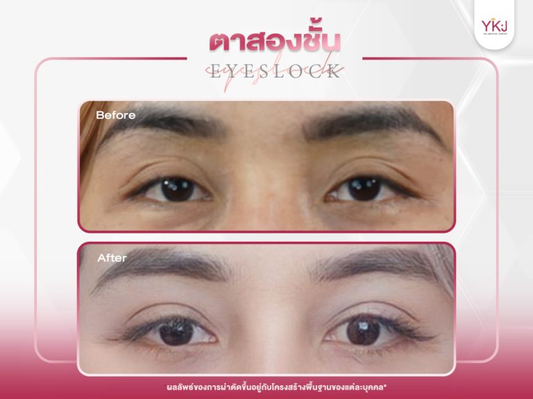 ภาพก่อนหลังทำตาสองชั้น แก้ตาสองชั้น