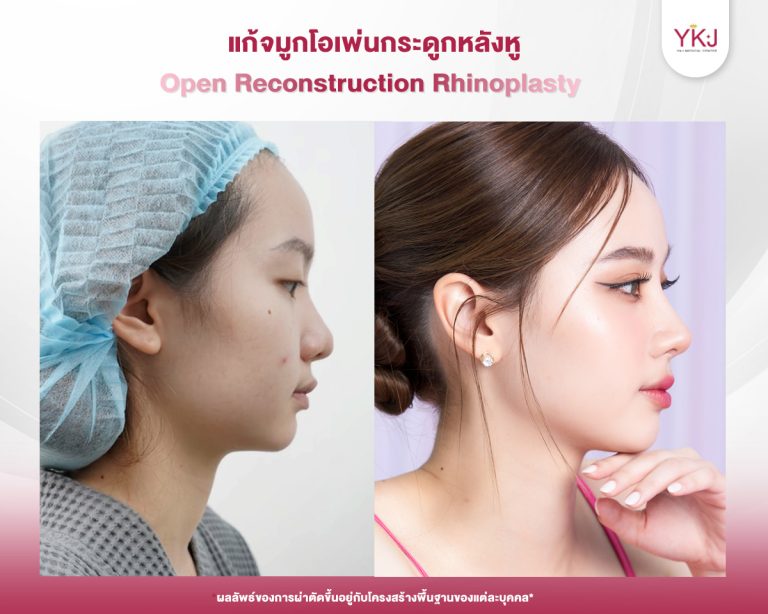 รีวิวแก้จมูก , รีวิวเสริมจมูกโอเพ่น , กระดูกอ่อนหลังหู