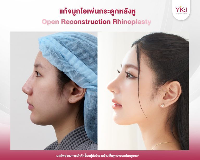 รีวิวแก้จมูก , รีวิวเสริมจมูกโอเพ่น , กระดูกอ่อนหลังหู
