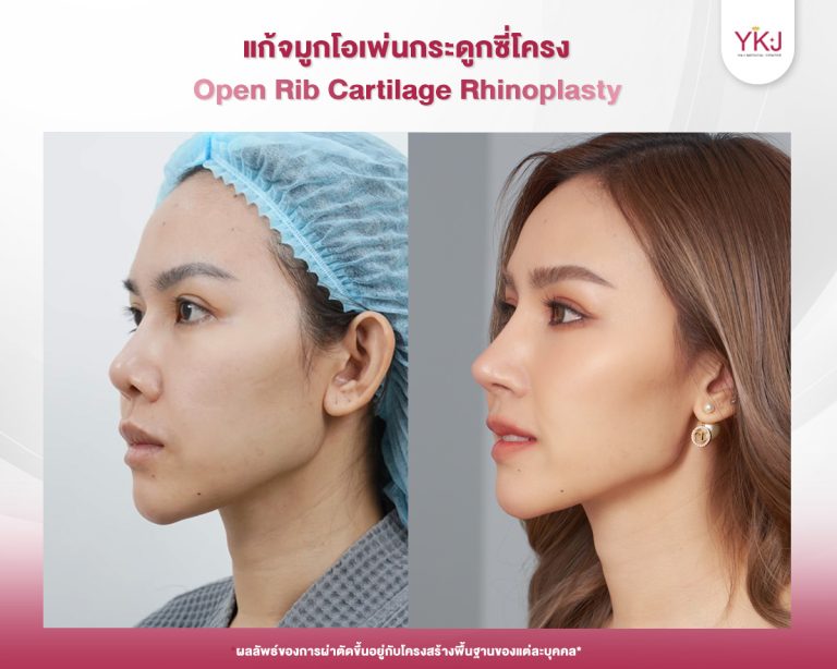 รีวิวแก้จมูก , รีวิวเสริมจมูกโอเพ่น , กระดูกซี่โครง
