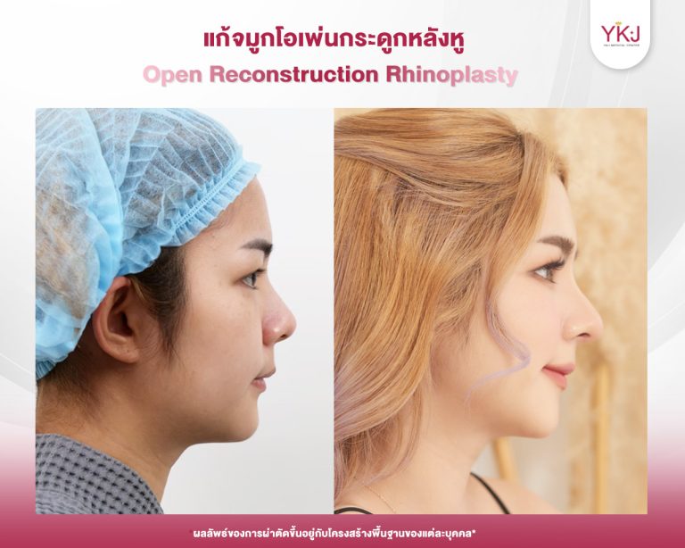 รีวิวแก้จมูก , รีวิวเสริมจมูกโอเพ่น , กระดูกอ่อนหลังหู
