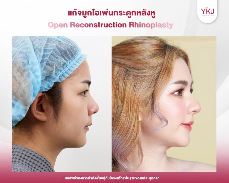 รีวิวแก้จมูก , รีวิวเสริมจมูกโอเพ่น , กระดูกอ่อนหลังหู