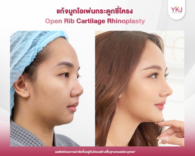 รีวิวแก้จมูก , รีวิวเสริมจมูกโอเพ่น , กระดูกซี่โครง