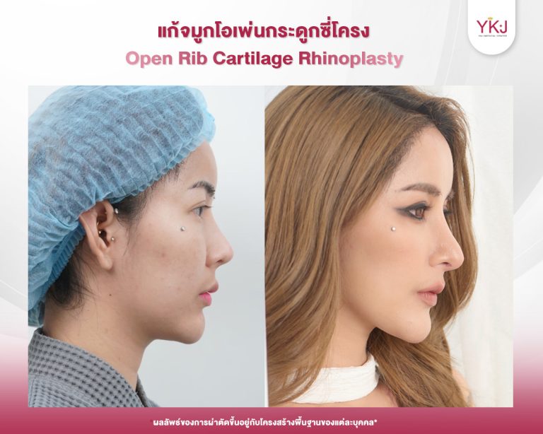 รีวิวแก้จมูก , รีวิวเสริมจมูกโอเพ่น , กระดูกซี่โครง