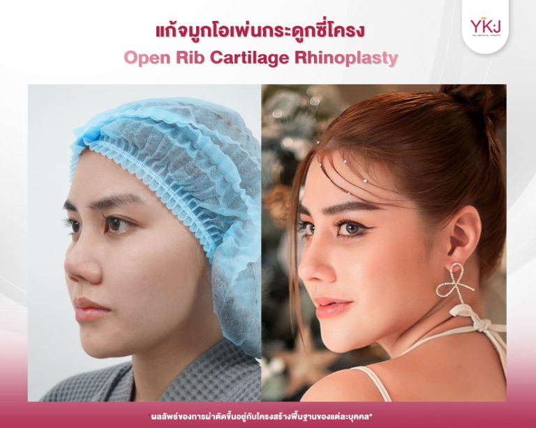 รีวิวแก้จมูก , รีวิวเสริมจมูกโอเพ่น , กระดูกซี่โครง