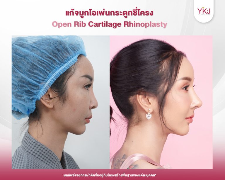 รีวิวแก้จมูก , รีวิวเสริมจมูกโอเพ่น , กระดูกซี่โครง