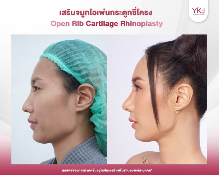 รีวิวแก้จมูก , รีวิวเสริมจมูกโอเพ่น , กระดูกซี่โครง