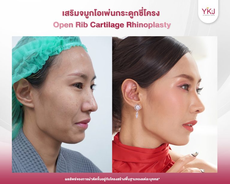 รีวิวแก้จมูก , รีวิวเสริมจมูกโอเพ่น , กระดูกซี่โครง