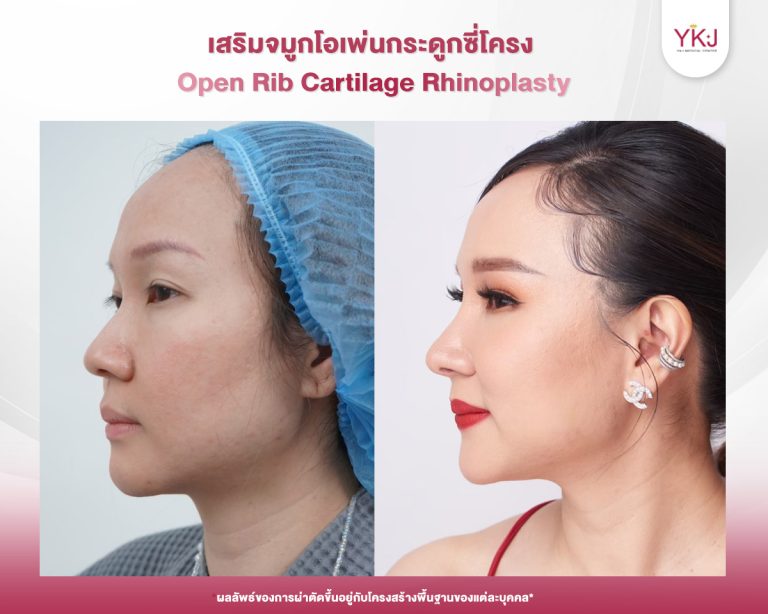 รีวิวแก้จมูก , รีวิวเสริมจมูกโอเพ่น , กระดูกซี่โครง