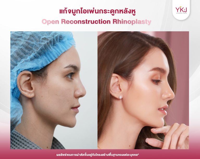 รีวิวแก้จมูก , รีวิวเสริมจมูกโอเพ่น , กระดูกอ่อนหลังหู