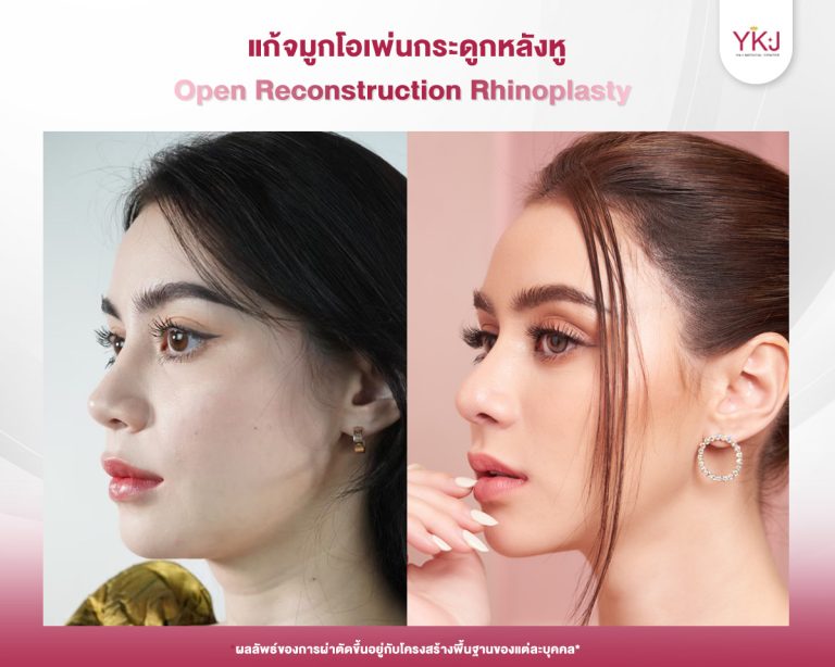 รีวิวแก้จมูก , รีวิวเสริมจมูกโอเพ่น , กระดูกอ่อนหลังหู