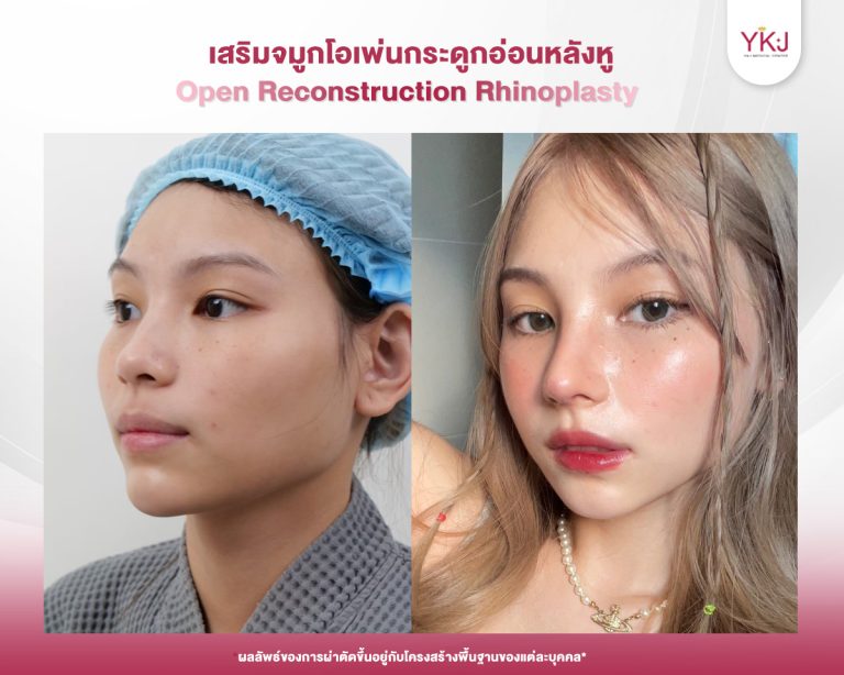 รีวิวแก้จมูก , รีวิวเสริมจมูกโอเพ่น , กระดูกอ่อนหลังหู