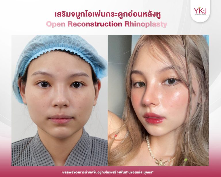 รีวิวแก้จมูก , รีวิวเสริมจมูกโอเพ่น , กระดูกอ่อนหลังหู