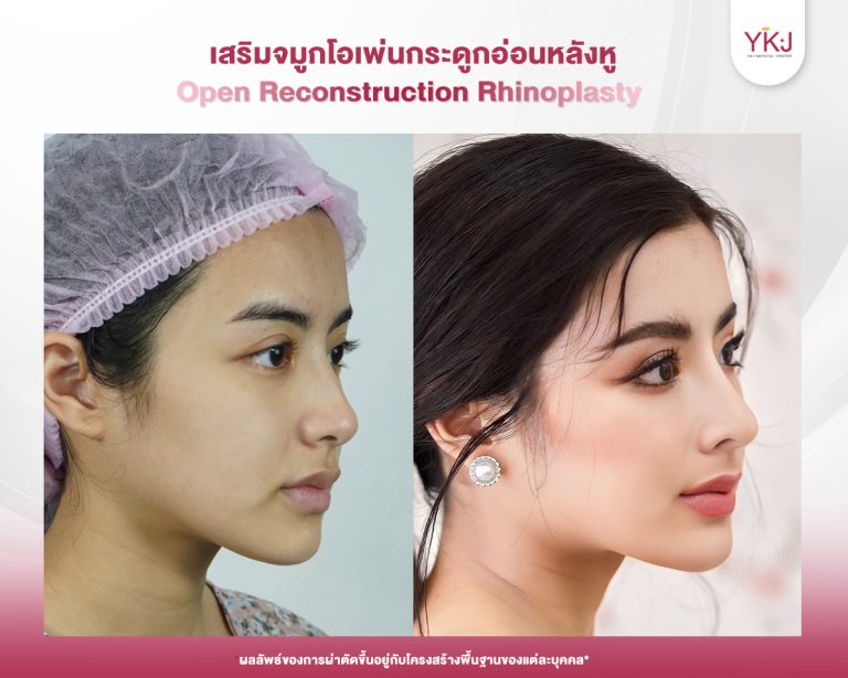 รีวิวแก้จมูก , รีวิวเสริมจมูกโอเพ่น , กระดูกอ่อนหลังหู