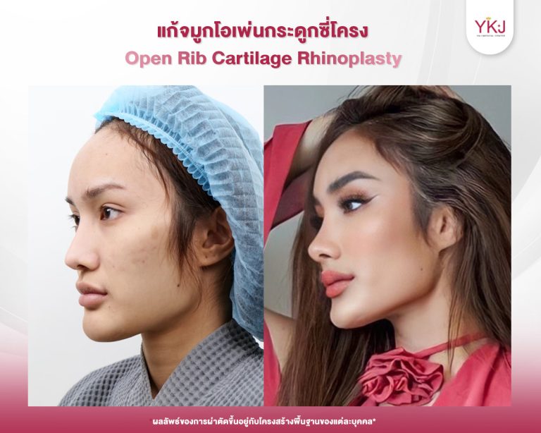 รีวิวแก้จมูก , รีวิวเสริมจมูกโอเพ่น , กระดูกซี่โครง