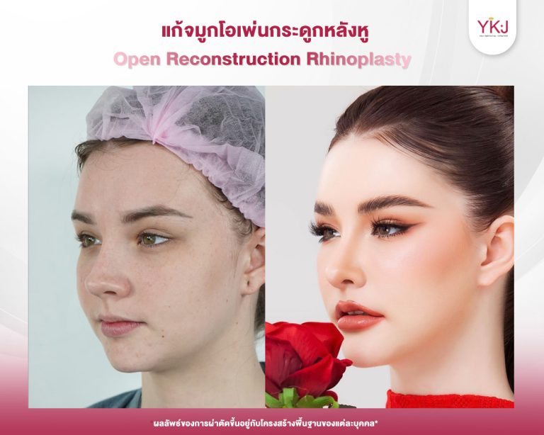 รีวิวแก้จมูก , รีวิวเสริมจมูกโอเพ่น , กระดูกอ่อนหลังหู
