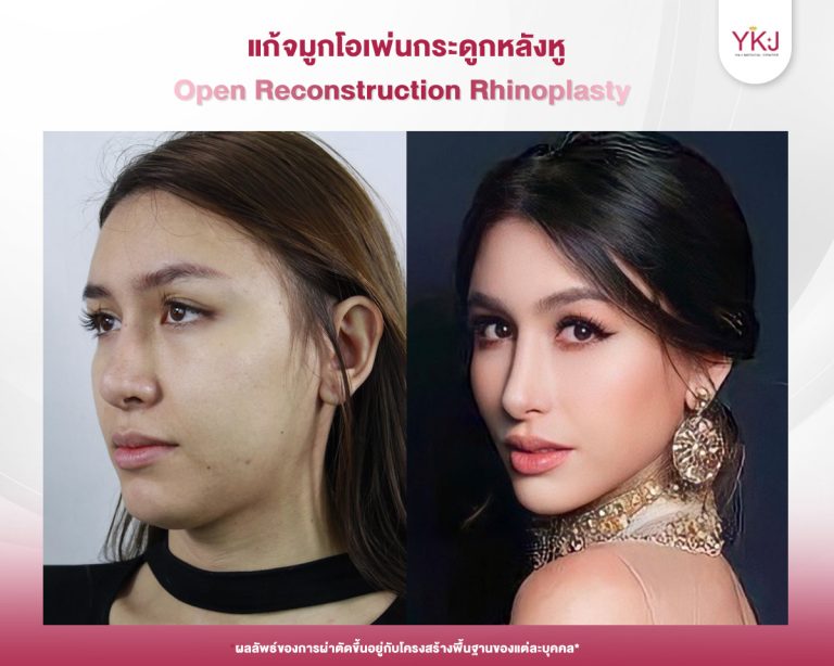 รีวิวแก้จมูก , รีวิวเสริมจมูกโอเพ่น , กระดูกอ่อนหลังหู