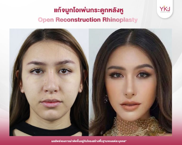 รีวิวแก้จมูก , รีวิวเสริมจมูกโอเพ่น , กระดูกอ่อนหลังหู