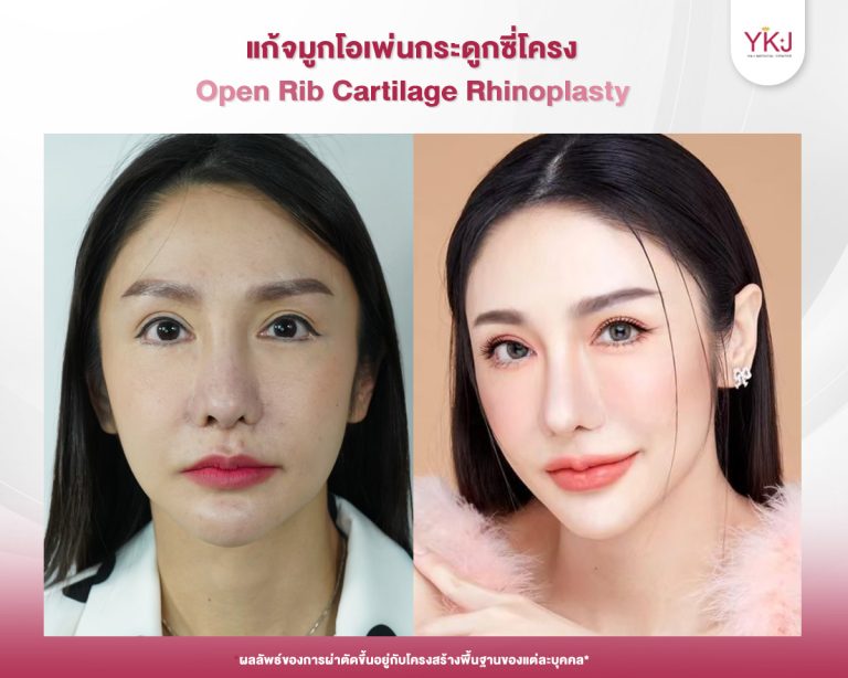 รีวิวแก้จมูก , รีวิวเสริมจมูกโอเพ่น , กระดูกซี่โครง