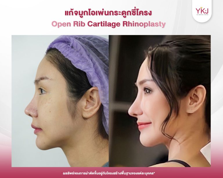 รีวิวแก้จมูก , รีวิวเสริมจมูกโอเพ่น , กระดูกซี่โครง