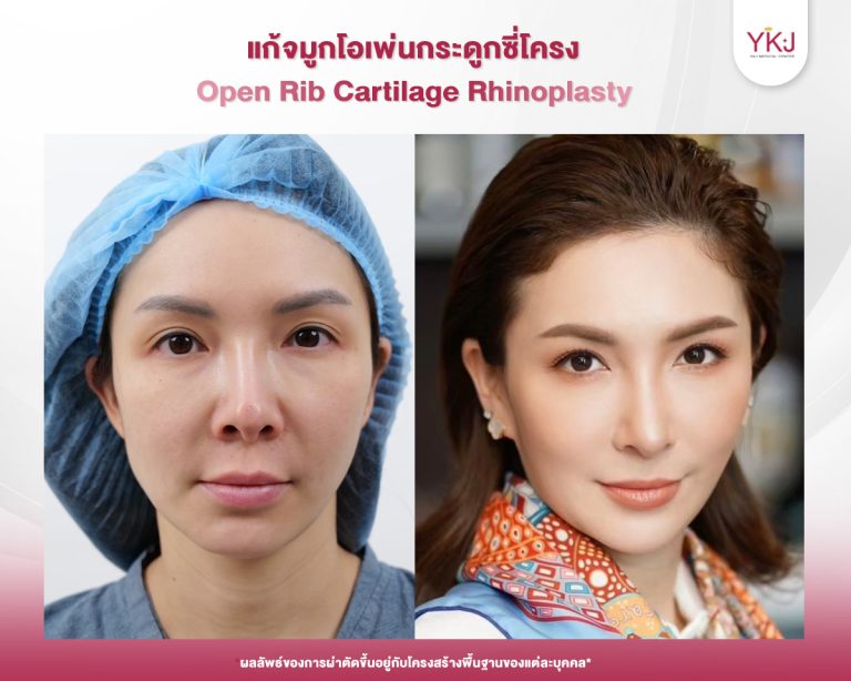 รีวิวแก้จมูก , รีวิวเสริมจมูกโอเพ่น , กระดูกซี่โครง