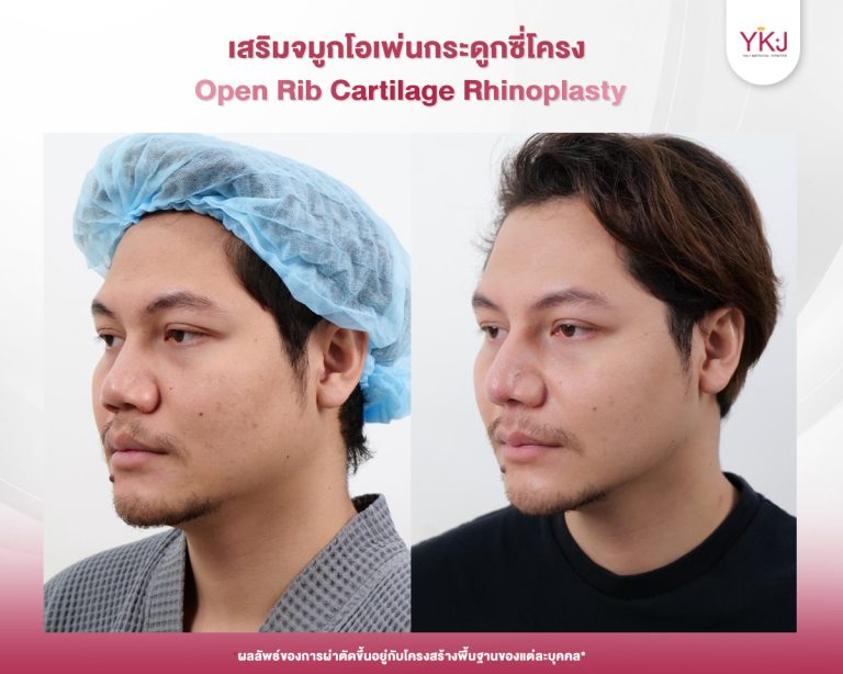 รีวิวแก้จมูก , รีวิวเสริมจมูกโอเพ่น , กระดูกซี่โครง