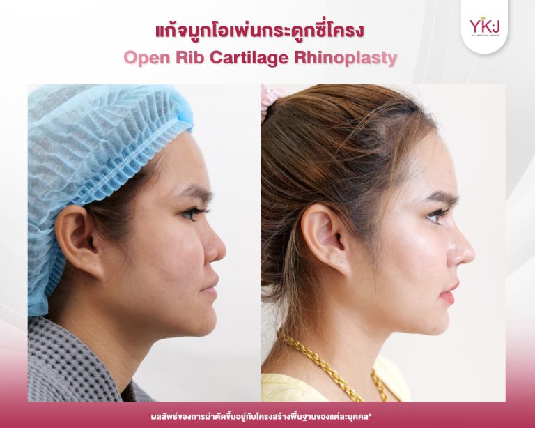 รีวิวแก้จมูก , รีวิวเสริมจมูกโอเพ่น , กระดูกซี่โครง