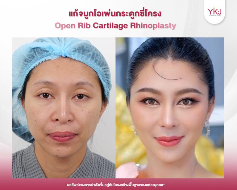 รีวิวแก้จมูก , รีวิวเสริมจมูกโอเพ่น , กระดูกซี่โครง