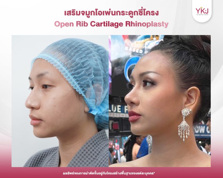 รีวิวแก้จมูก , รีวิวเสริมจมูกโอเพ่น , กระดูกซี่โครง