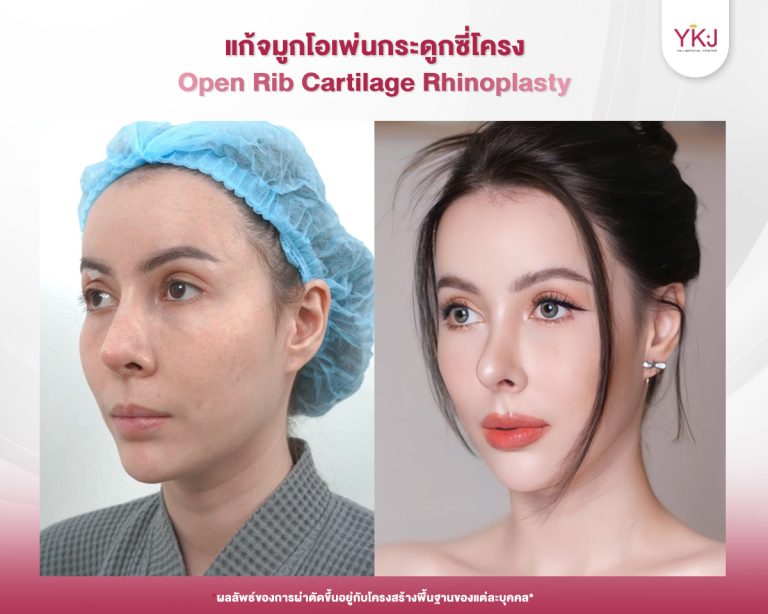 รีวิวแก้จมูก , รีวิวเสริมจมูกโอเพ่น , กระดูกซี่โครง