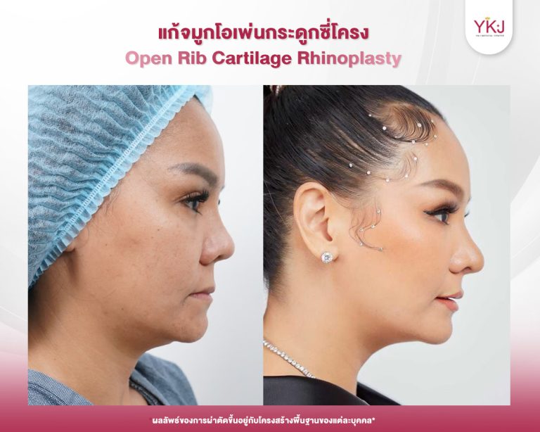 รีวิวแก้จมูก , รีวิวเสริมจมูกโอเพ่น , กระดูกซี่โครง