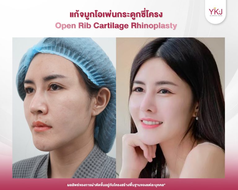 รีวิวแก้จมูก , รีวิวเสริมจมูกโอเพ่น , กระดูกซี่โครง