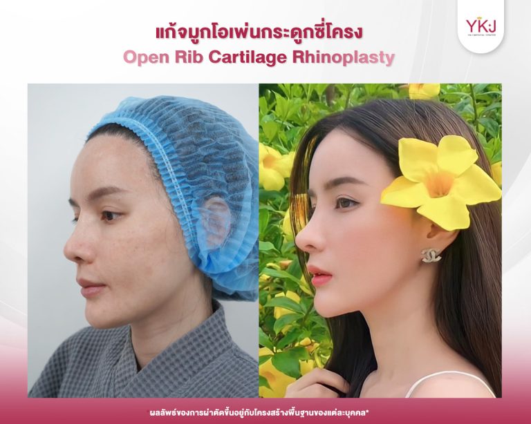 รีวิวแก้จมูก , รีวิวเสริมจมูกโอเพ่น , กระดูกซี่โครง
