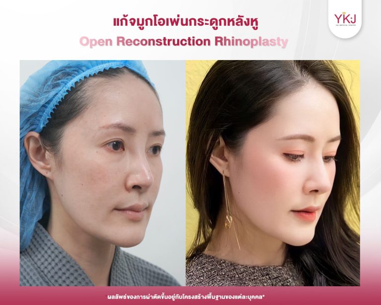 รีวิวแก้จมูก , รีวิวเสริมจมูกโอเพ่น , กระดูกอ่อนหลังหู