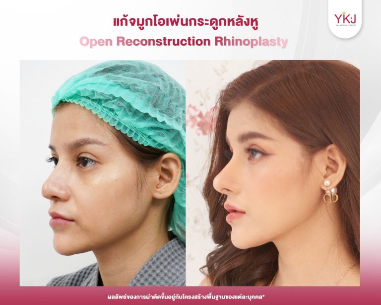 รีวิวแก้จมูก , รีวิวเสริมจมูกโอเพ่น , กระดูกอ่อนหลังหู