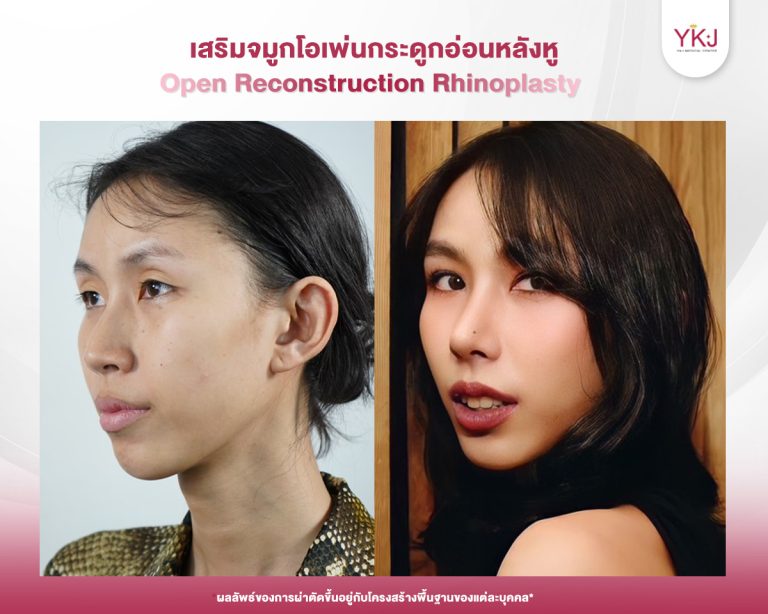 รีวิวแก้จมูก , รีวิวเสริมจมูกโอเพ่น , กระดูกอ่อนหลังหู