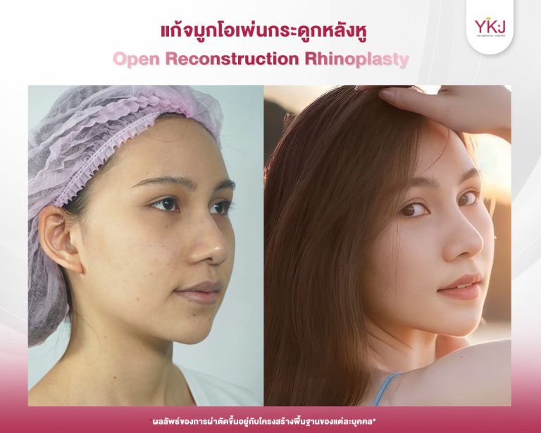 รีวิวแก้จมูก , รีวิวเสริมจมูกโอเพ่น , กระดูกอ่อนหลังหู