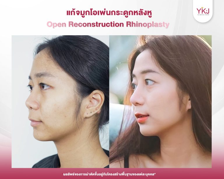 รีวิวแก้จมูก , รีวิวเสริมจมูกโอเพ่น , กระดูกอ่อนหลังหู