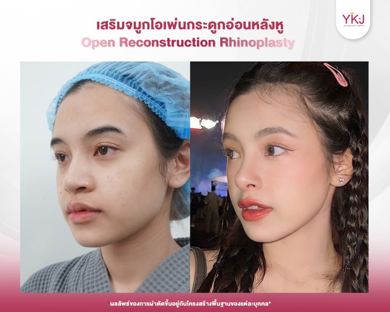 รีวิวแก้จมูก , รีวิวเสริมจมูกโอเพ่น , กระดูกอ่อนหลังหู